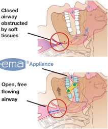 ema-infographic