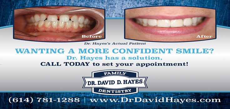 veneer Dr Hayes - Dentist - Westerville, Ohio - Columbus, Ohio